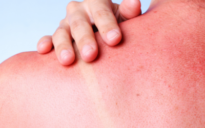 How to Choose the Right Sunscreen for Your Skin Type | Best SPF for Acne-Prone, Sensitive & Dry Skin