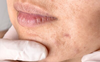 Brown Spots After Summer? Causes & Treatment Options